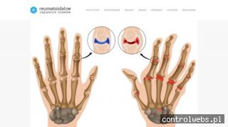 Reumatoidalne zapalenie stawów
