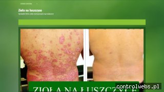 Łuszczyca- ziola-na-luszczyce.pl